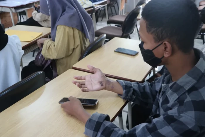 Robit yang menunjukkan luka kecelakaannya namun tetap ikut SNBT