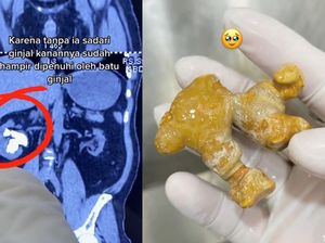 Viral Wanita Punya Batu Ginjal Sebesar Jahe, Ternyata Ini Pemicunya