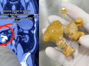 Viral Batu Ginjal Seukuran Jahe, Gegara Doyan Minum Manis-Sering Nahan Pipis?