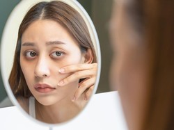 Viral Fenomena Cortisol Face, Benarkah Wajah Bengkak Karena Stres?