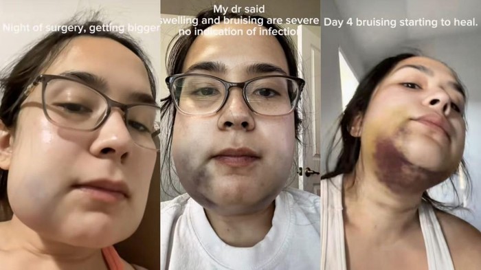 Viral Kisah Wanita Cabut Gigi Bungsu, Berujung Rahang Bengkak dan Memar