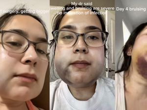Viral Kisah Wanita Cabut Gigi Bungsu, Berujung Rahang Bengkak dan Memar
