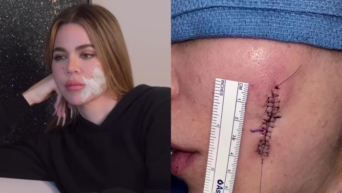 Khloe Kardashian Buka-bukaan Kondisi Terbarunya Pasca Operasi Kanker Kulit