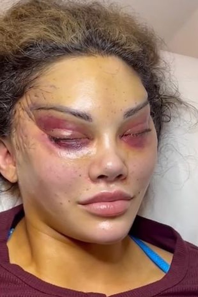 Prosedur dilakukan dengan menarik sudut matanya hingga ke dekat dahi untuk menciptakan bentuk almod yang menyerupai fitur mata kucing. Foto: Instagram/@aesthetic_clinic_london