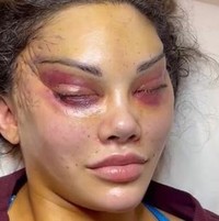 Prosedur dilakukan dengan menarik sudut matanya hingga ke dekat dahi untuk menciptakan bentuk almod yang menyerupai fitur mata kucing. Foto: Instagram/@aesthetic_clinic_london