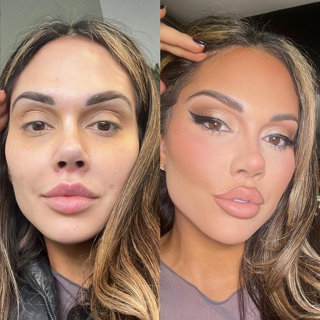 “Operasi ini disebut mata kucing dan dilakukan dengan cara mengangkat sudut mata dan pengencangan pipi agar bagian tengah wajah dan pipi lebih terangkat,” jelas Dr Hakan Ozocak, spesialis bedah plastik yang mengoperasi wajah Nasrin. Foto: Instagram/@aesthetic_clinic_london