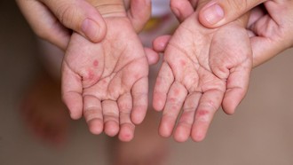 Australia Temukan Virus Campak 'Bawaan' dari Indonesia, Pakar Soroti Hal Ini