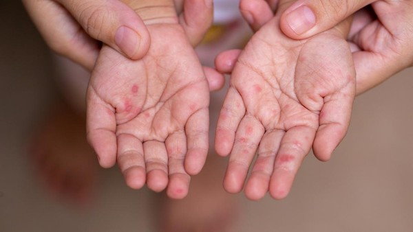 IDAI Sebut Campak Lebih Menular dari COVID-19, Ingatkan Pentingnya  Imunisasi pada Anak