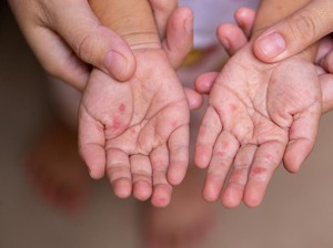 Menkes Sebut Kasus Campak Ngegas di RI, Inikah Biang Keroknya?