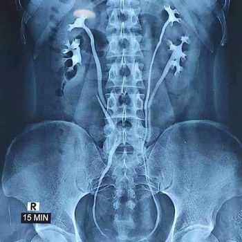 Organ Berlebih Viral postingan foto X-Ray menunjukkan seseorang memiliki empat ginjal.