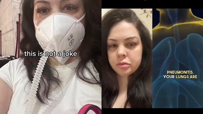 Nge-vape Selama 4 Bulan buat Gantikan Rokok, Wanita Ini Kena Radang Paru-paru