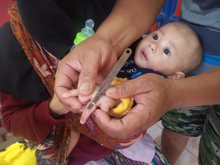 Petugas saat melepas cincin di jari bayi