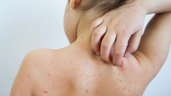 13 Penyebab Bintik Merah pada Kulit, Kapan Harus ke Dokter?