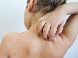 13 Penyebab Bintik Merah pada Kulit, Kapan Harus ke Dokter?