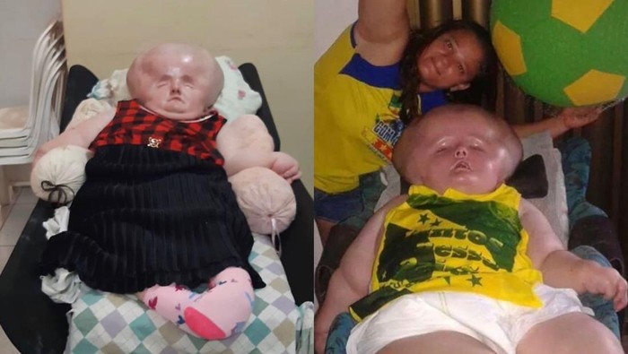 Kepala Wanita 29 Tahun Ini Membesar 3 Kali Lipat, Tak Bisa Bergerak dan Melihat