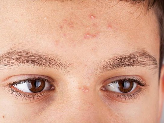 Forehead of a teenage boy with pimples