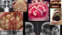 Hyperdontia atau supernumerary teeth adalah kondisi yang membuat pengidapnya mengalami kelebihan gigi di mulut. Foto: Twitter/creepy_org  