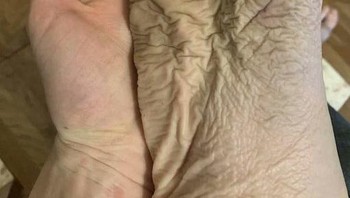 Kaki setelah memakai boot basah selama 10 jam Foto: Twitter/creepy_org