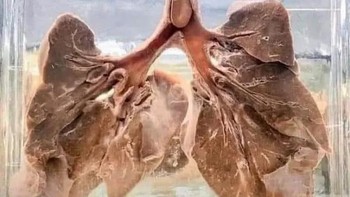 Kacang bersarang di dalam trakea anak Foto: Twitter/creepy_org