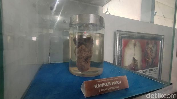 Museum Kanker Indonesia berada di Jalan Kayoon 16-18 Surabaya. Ini merupakan museum kanker pertama dan satu-satunya di dunia.