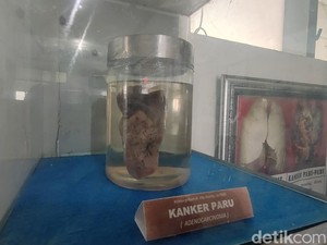 37 Jenis Kanker dan Cara Mengobatinya Menurut dr Ananto