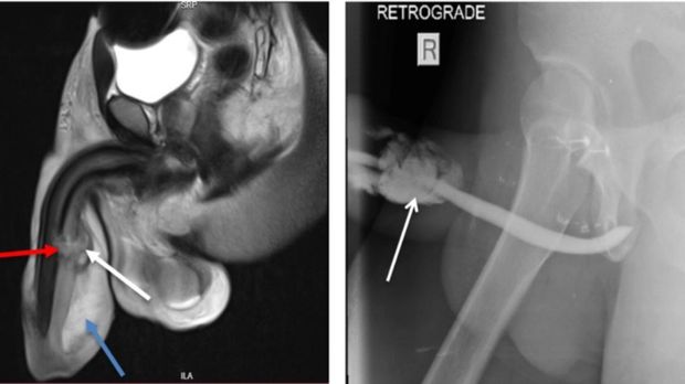 penis patah penis patah