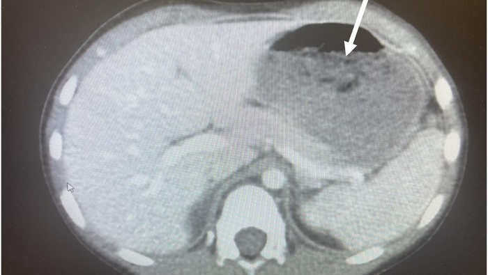 Duh! Bocah 5 Tahun Tak Sengaja Telan 40 Permen Karet, Berakhir di Meja Operasi