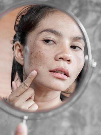 Ini Masalah Kulit Paling Umum yang Dialami 73% Wanita Indonesia