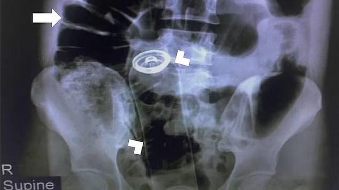 Demi Kepuasan Seks, Pria Ini Nekat Masukkan Deodoran ke Anusnya