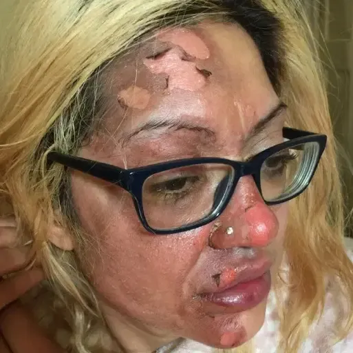 Apes! Wajah Wanita Ini Terbakar Usai Coba Resep Telur Viral di TikTok