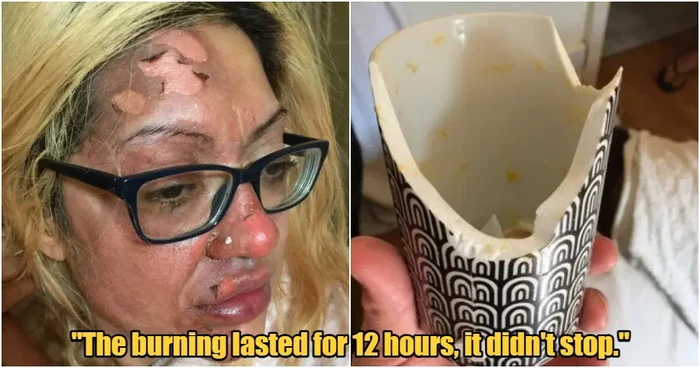 Apes! Wajah Wanita Ini Terbakar Usai Coba Resep Telur Viral di TikTok