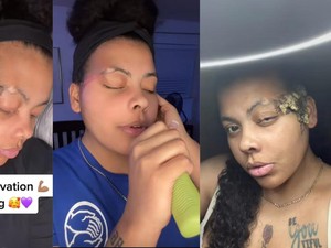 Viral Wanita Idap Penyakit Langka Berawal dari Tanda Lahir, Ini Gejala Awalnya