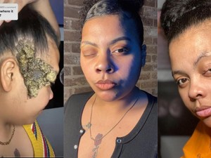 Awal Mula Wanita Kena Kelainan Genetik, Sempat Dikira Cuma Tanda Lahir