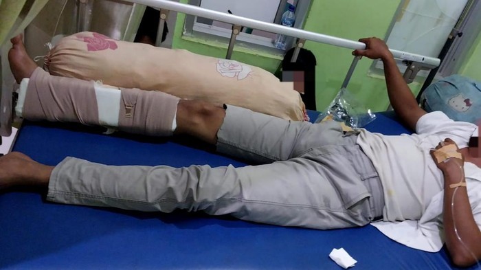 Korban ASN yang patah kaki menjalani perawatan terbaring di Rumah Sakit Umum Daerah Bangka Selatan.
