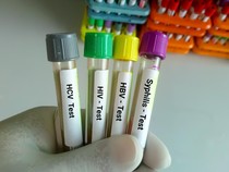 Dinkes Parepare Tangani 128 Penderita HIV/AIDS, 60 Pasien dari Luar Daerah