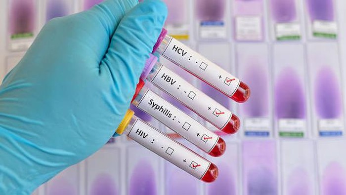 Blood sample positive with sexually transmitted diseases: HIV, HBV, HCV, Syphilis