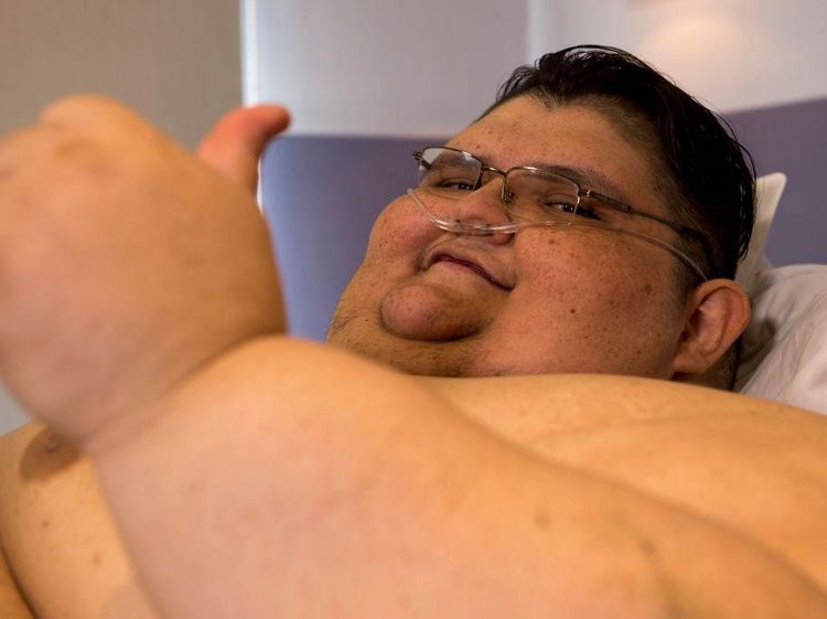 Potret Pria Tergemuk di Dunia yang Berakhir Tragis, Meninggal karena Infeksi Ginjal