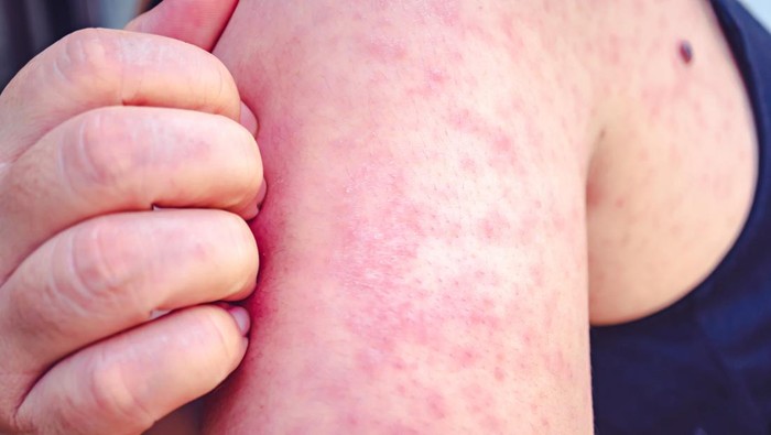 Measles, Women scratch the upper arm with one hand due to the numerous red pruritus., Measles is a disease that can spread easily.