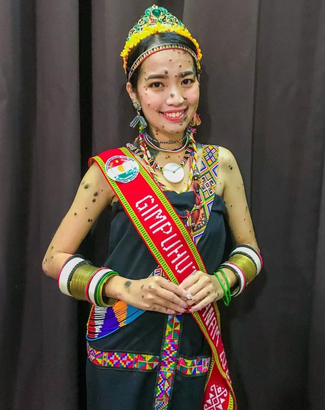 Evita Patcey Edgar Delmundo menidap kondisi langka yang dinamakan Giant Congenital Melanocytic Nevus yang menyebabkan tubuhnya ditumbuhi bintik kecil berwarna kehitaman di atas permukaan kulit. Foto: Instagram/@evita_delmundo