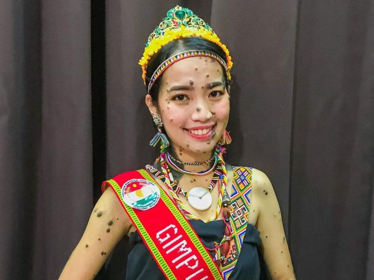 7 Foto Wanita Dulu Viral Wajah dan Tubuh Penuh Tahi Lalat, Nasibnya Kini...