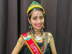 7 Foto Wanita Dulu Viral Wajah dan Tubuh Penuh Tahi Lalat, Nasibnya Kini...