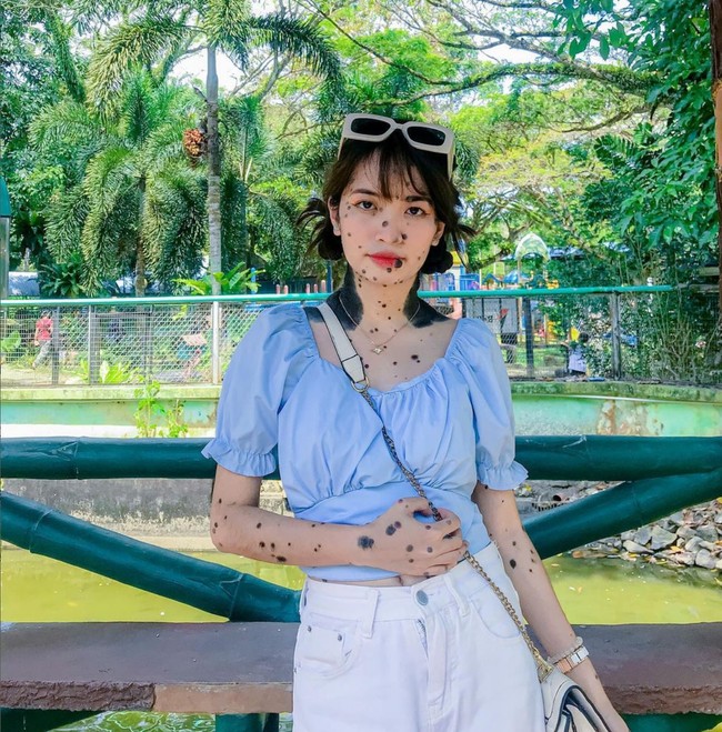 Kondisinya ini membuat dia acap kali jadi sasaran bully dari teman-temannya. Wanita berdarah campuran Malaysia dan Filipina ini dijuluki monster atau Chips More, merek cookies dengan chocochip. Foto: Instagram/@evita_delmundo