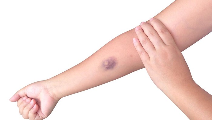 Bukan Dijilat Jin! Luka Lebam yang Tetiba Muncul Bisa Jadi Indikasi Penyakit Ini