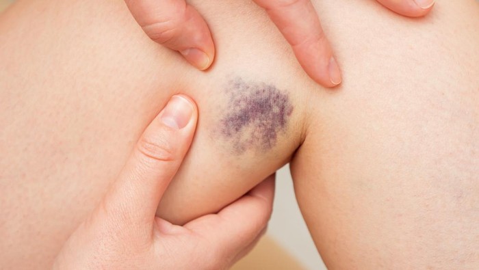 Tetiba Muncul Memar di Kulit? Waspadai Kelainan Pembuluh Darah-Kanker