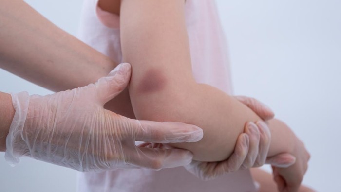 Tiba-tiba Muncul Luka Memar di Kulit, Gegara Dijilat Jin? Begini Faktanya!