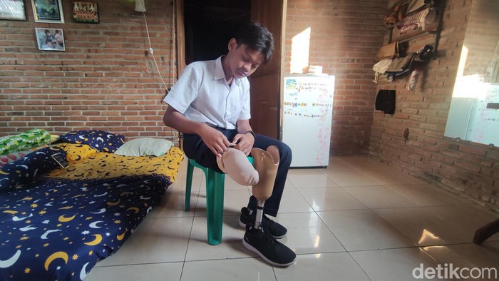 Bocah Sidoarjo alami kelainan tulang kaki sejak dalam kandungan