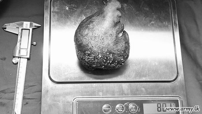 Heboh Batu Ginjal Terbesar di Dunia, Urolog Beberkan Kemungkinan Pemicunya