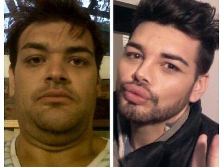 Transformasi Pria yang Nekat Suntikkan Oli ke Wajah demi Mirip Ricky Martin