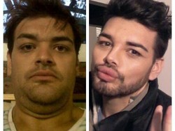 Transformasi Pria yang Nekat Suntikkan Oli ke Wajah demi Mirip Ricky Martin