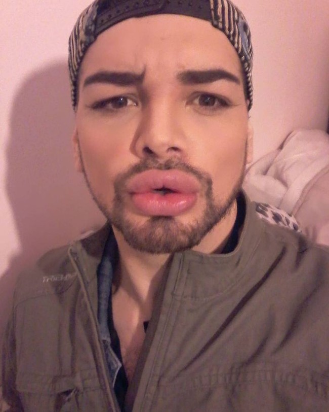 Aku tidak bisa merasakan setengah wajahku. Aku tidak bisa merasakan hidung, aku tidak merasakan daguku. Ketika aku meminum sampanye, aku harus melakukannya dengan bantuan serbet karena airnya tumpah (tidak tertelan semua), kata Fran, dilansir Semana.Foto: Instagram Fran Mariano